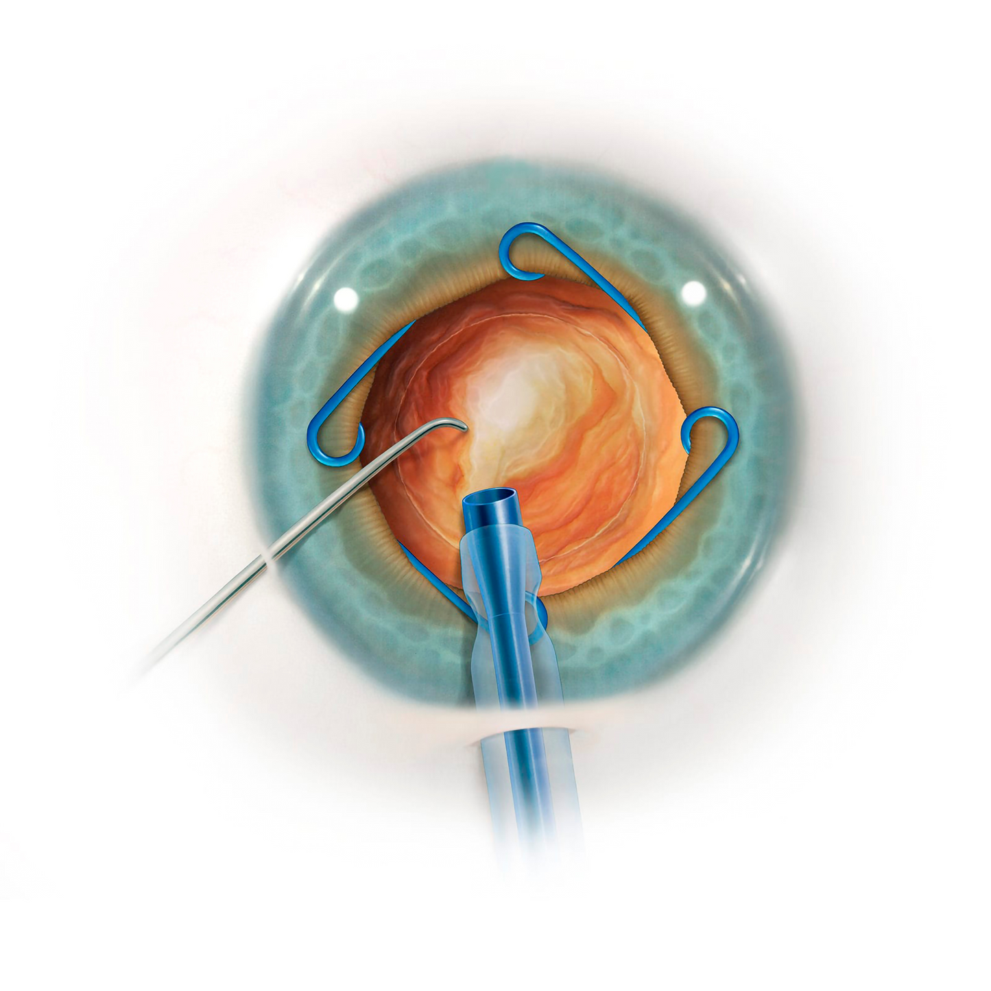 Anillo Malyugin 2.0, 6.25mm