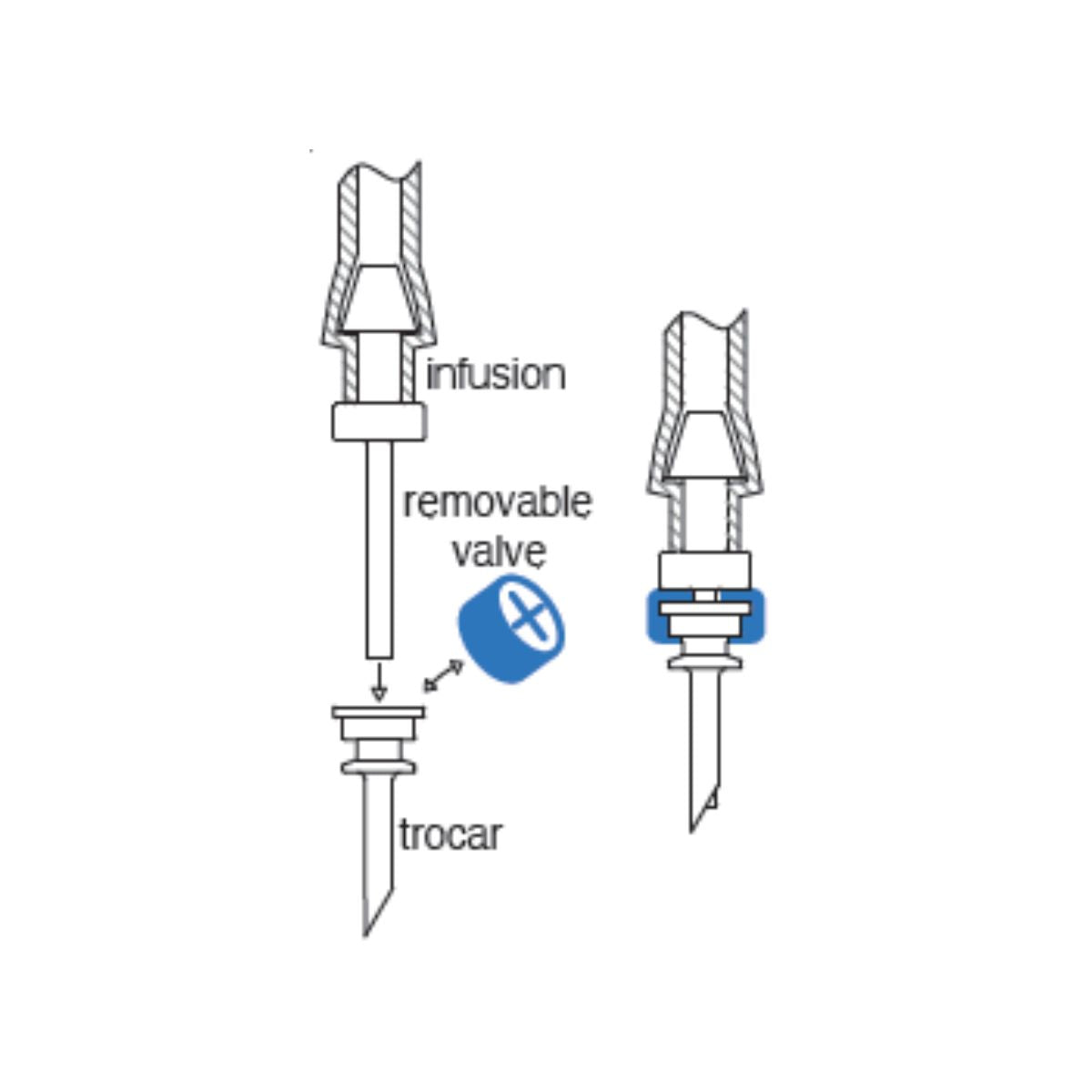Set de trócares con válvula extraíble de 25G, estériles, desechables